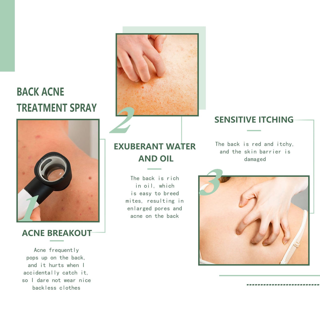VELOUR Back Acne Repair Spray