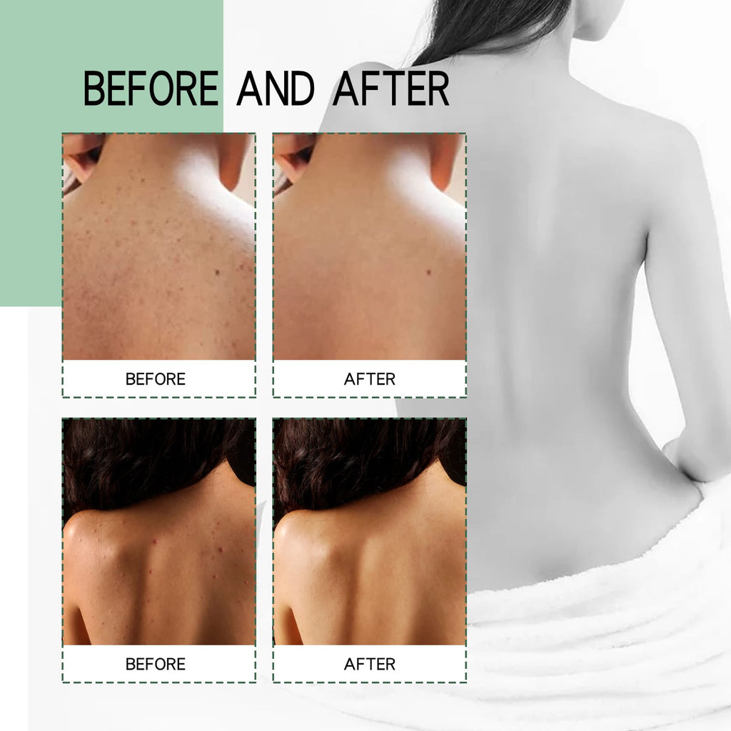 VELOUR Back Acne Repair Spray